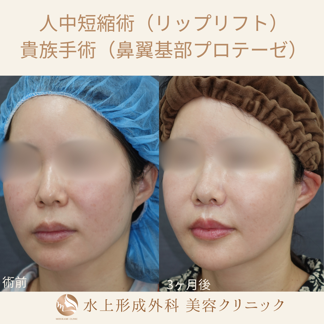 人中短縮術（リップリフト）、貴族手術（鼻翼基部プロテーゼ）