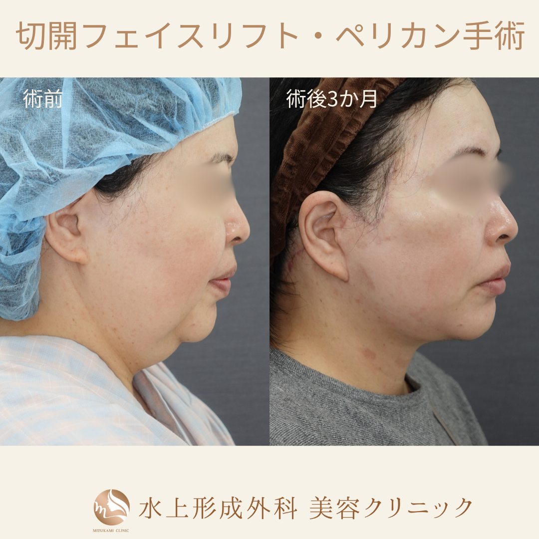 切開フェイスリフト・ペリカン手術の症例写真3