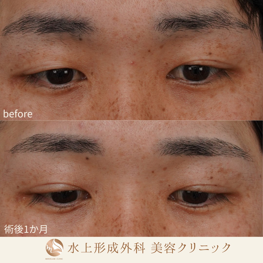二重埋没法の症例写真2