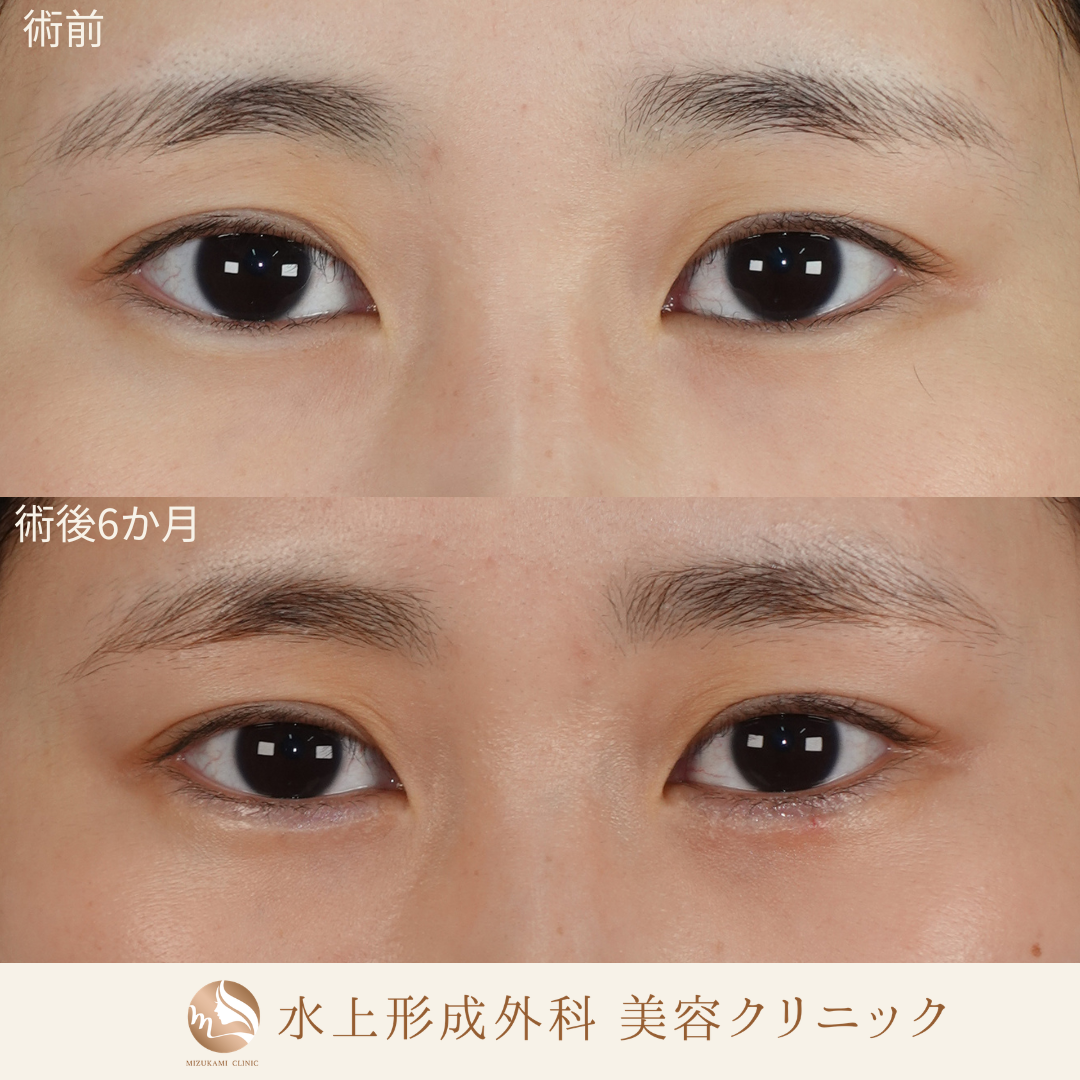逆さまつ毛手術