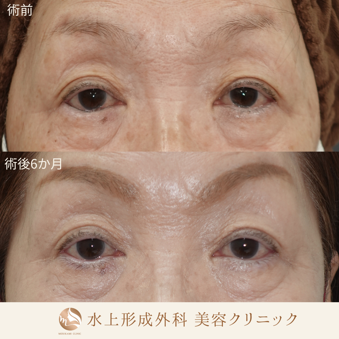 逆さまつ毛手術