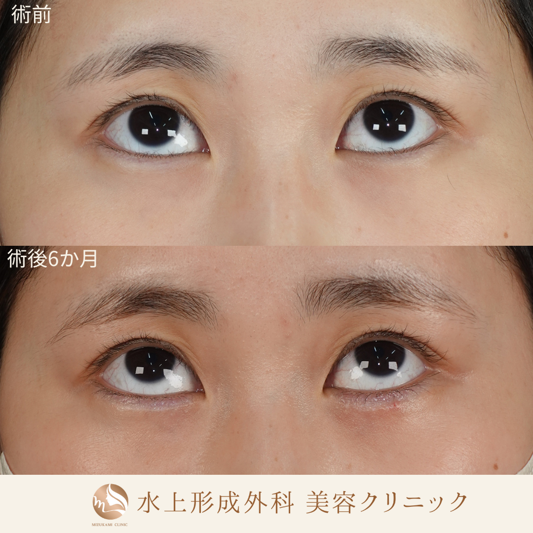 逆さまつ毛手術の症例写真2