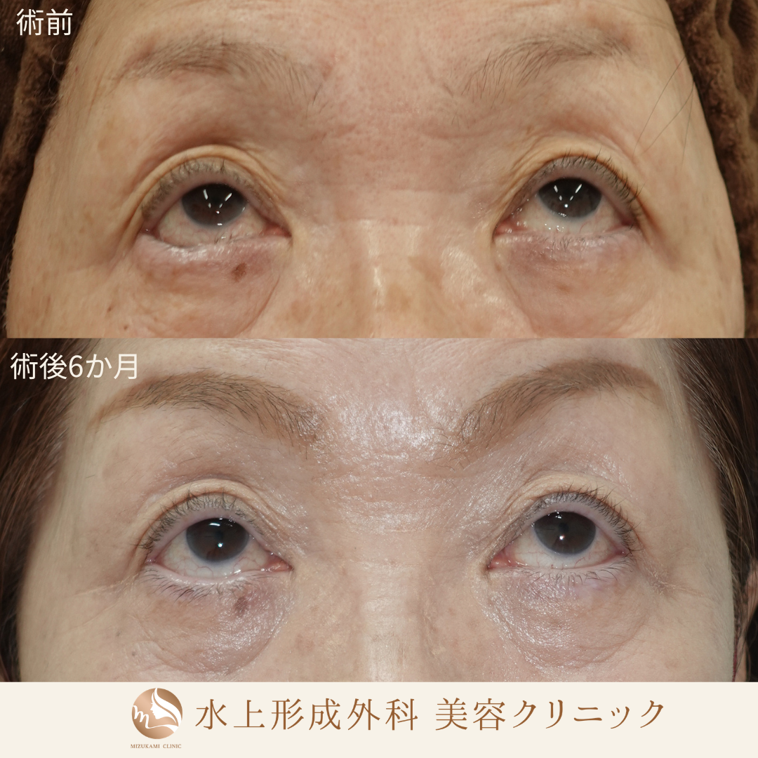 逆さまつ毛手術の症例写真2