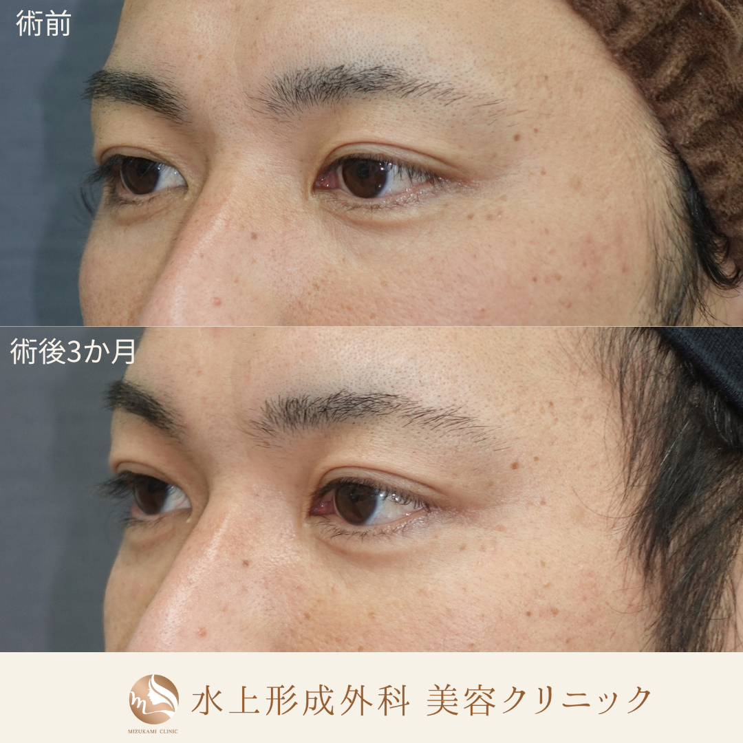 クマ取り（裏ハムラ）の症例写真2
