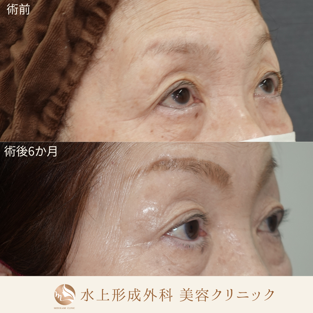 逆さまつ毛手術の症例写真3