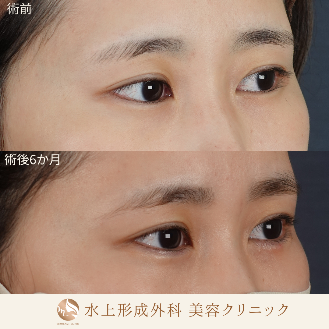 逆さまつ毛手術の症例写真3