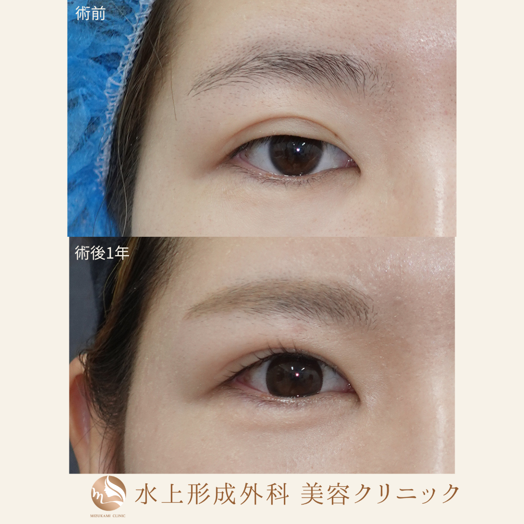 眼瞼下垂症手術（他院修正）