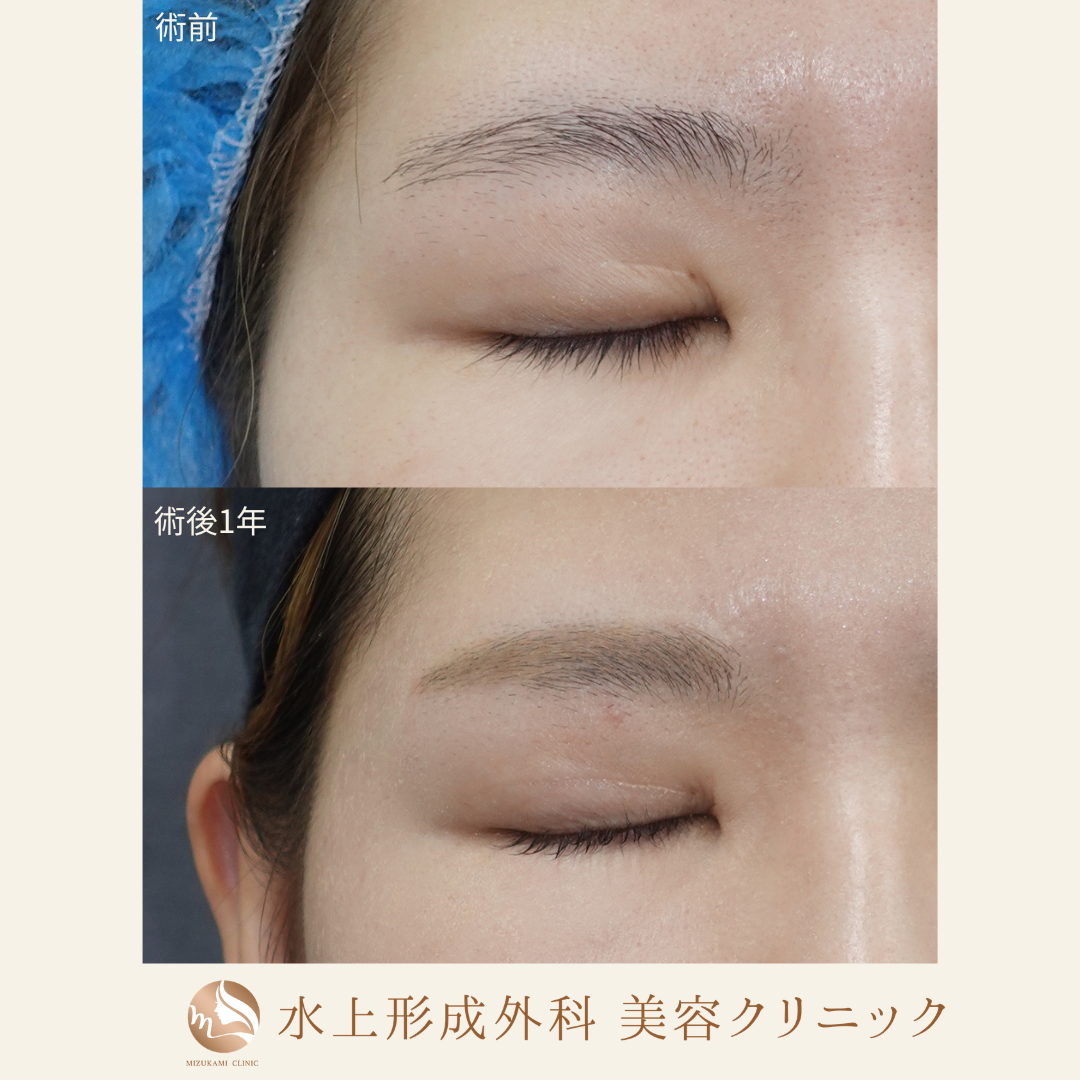 眼瞼下垂症手術（他院修正）の症例写真2