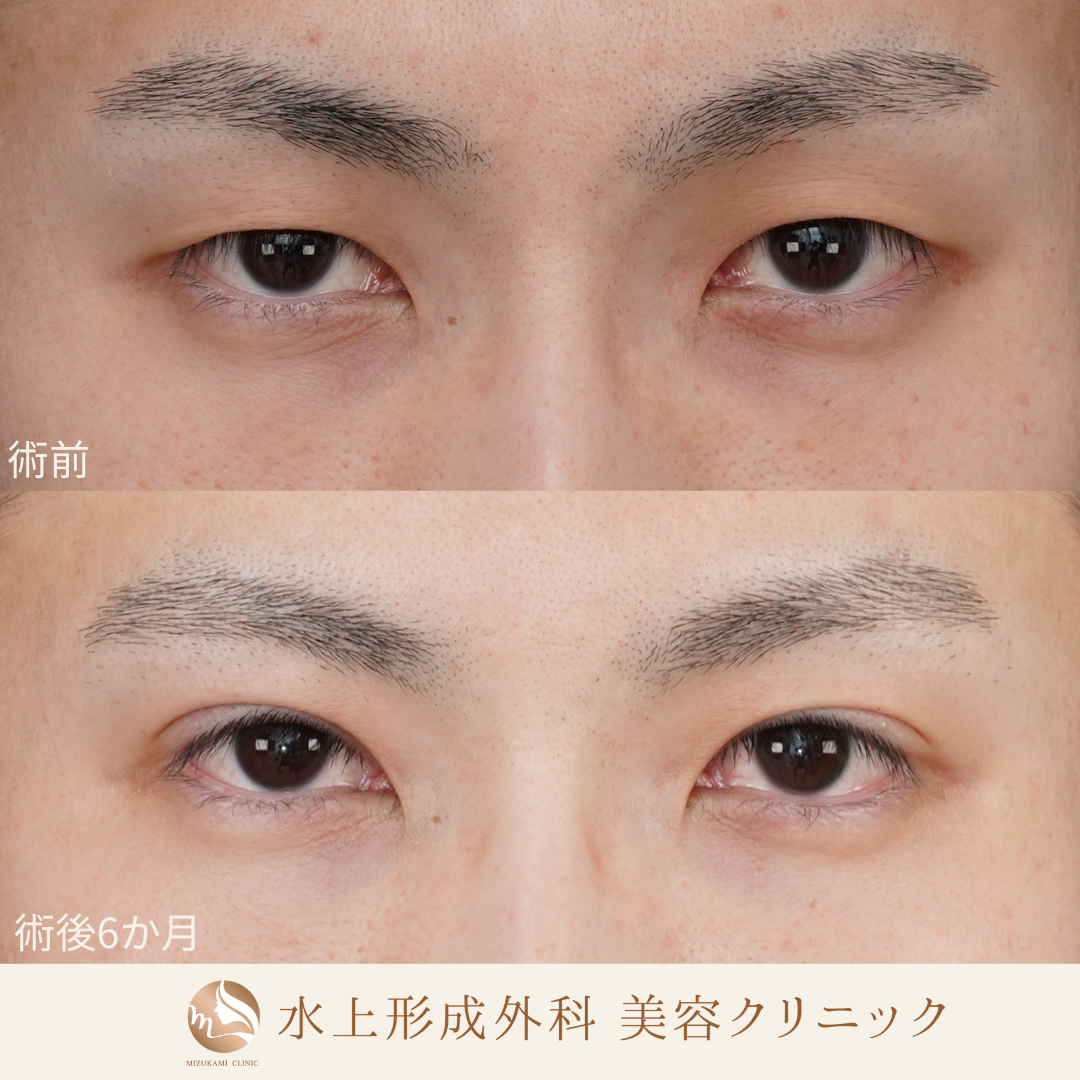 眼瞼下垂症手術・上眼瞼逆さまつ毛