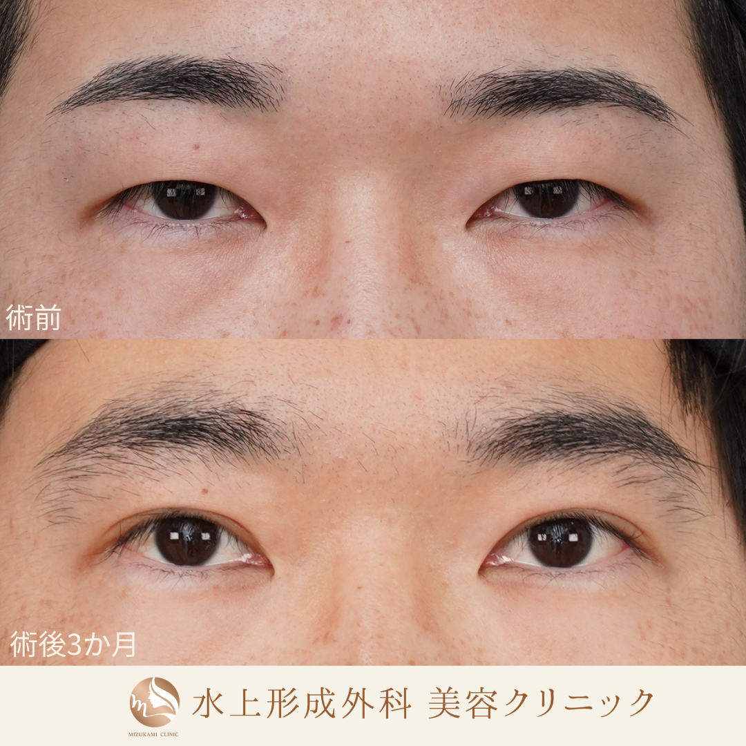 眼瞼下垂症手術