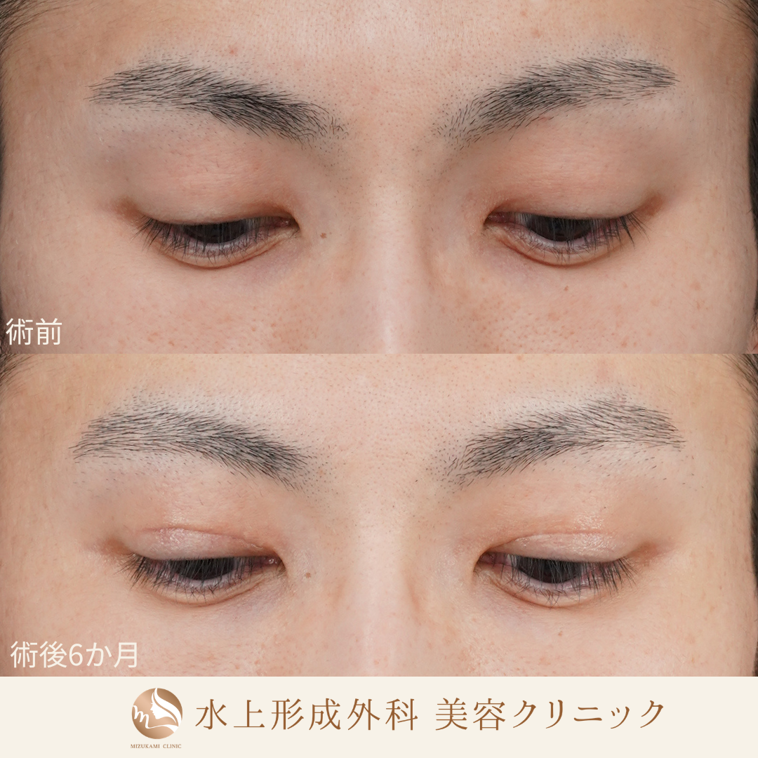 眼瞼下垂症手術・上眼瞼逆さまつ毛の症例写真2