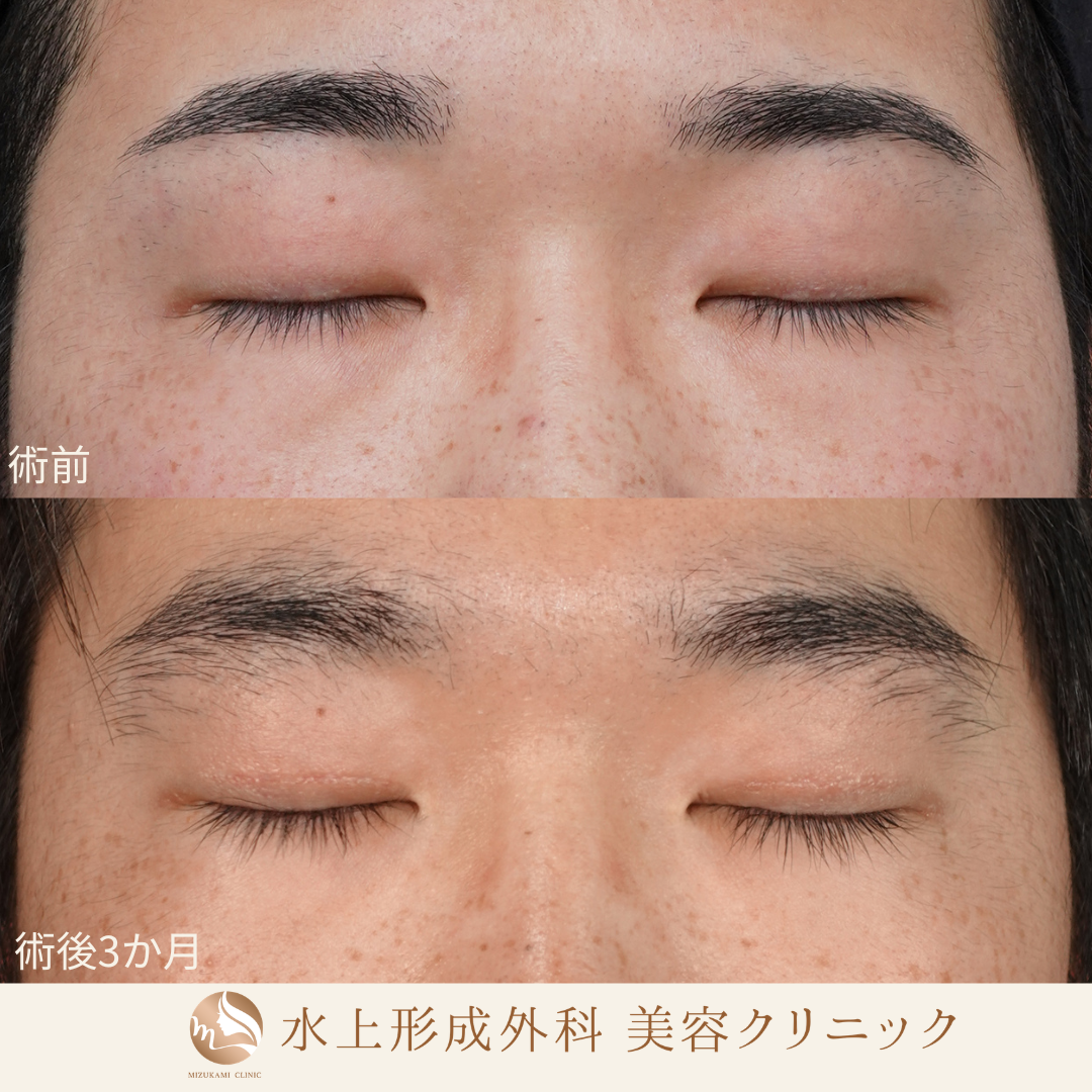 眼瞼下垂症手術の症例写真2