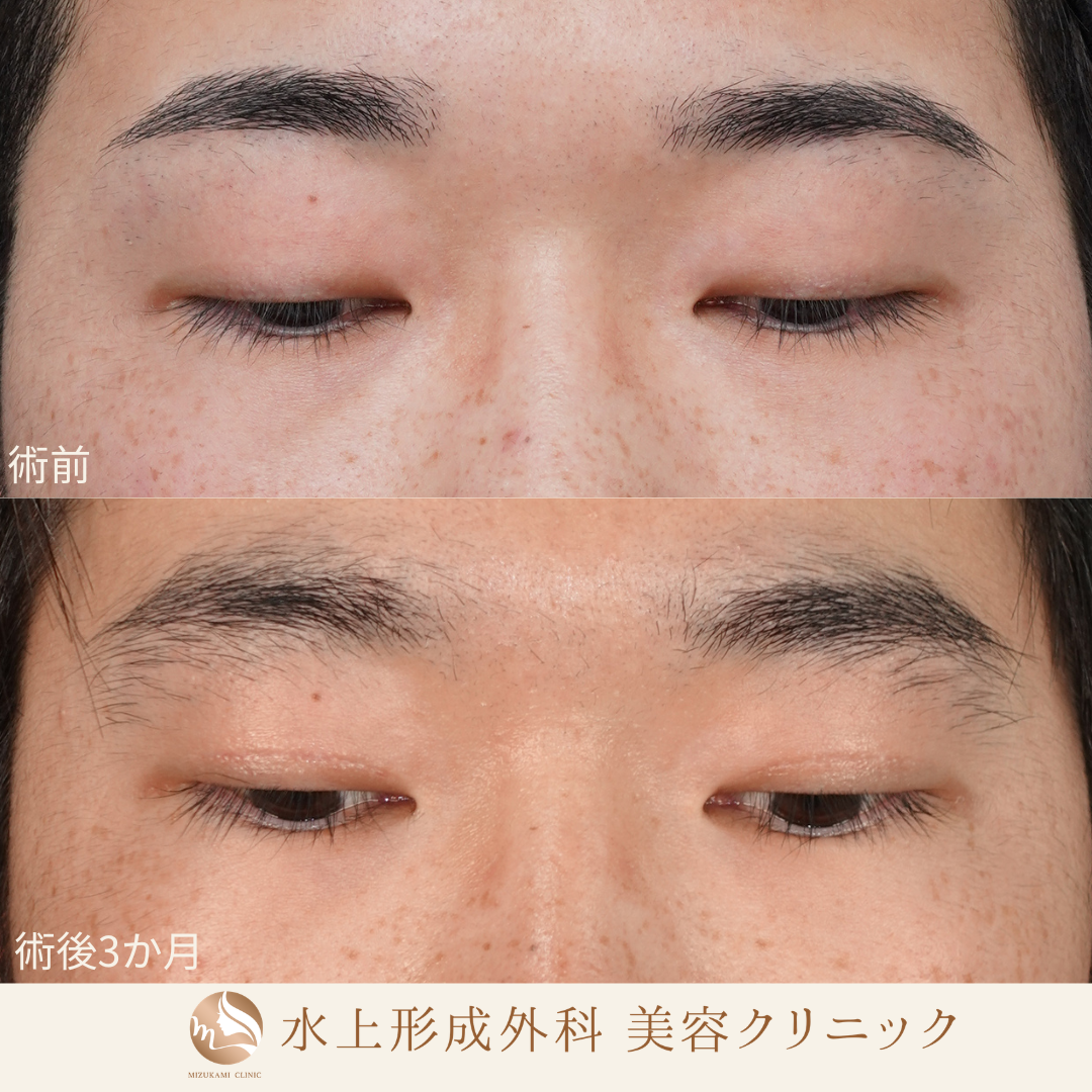眼瞼下垂症手術の症例写真3