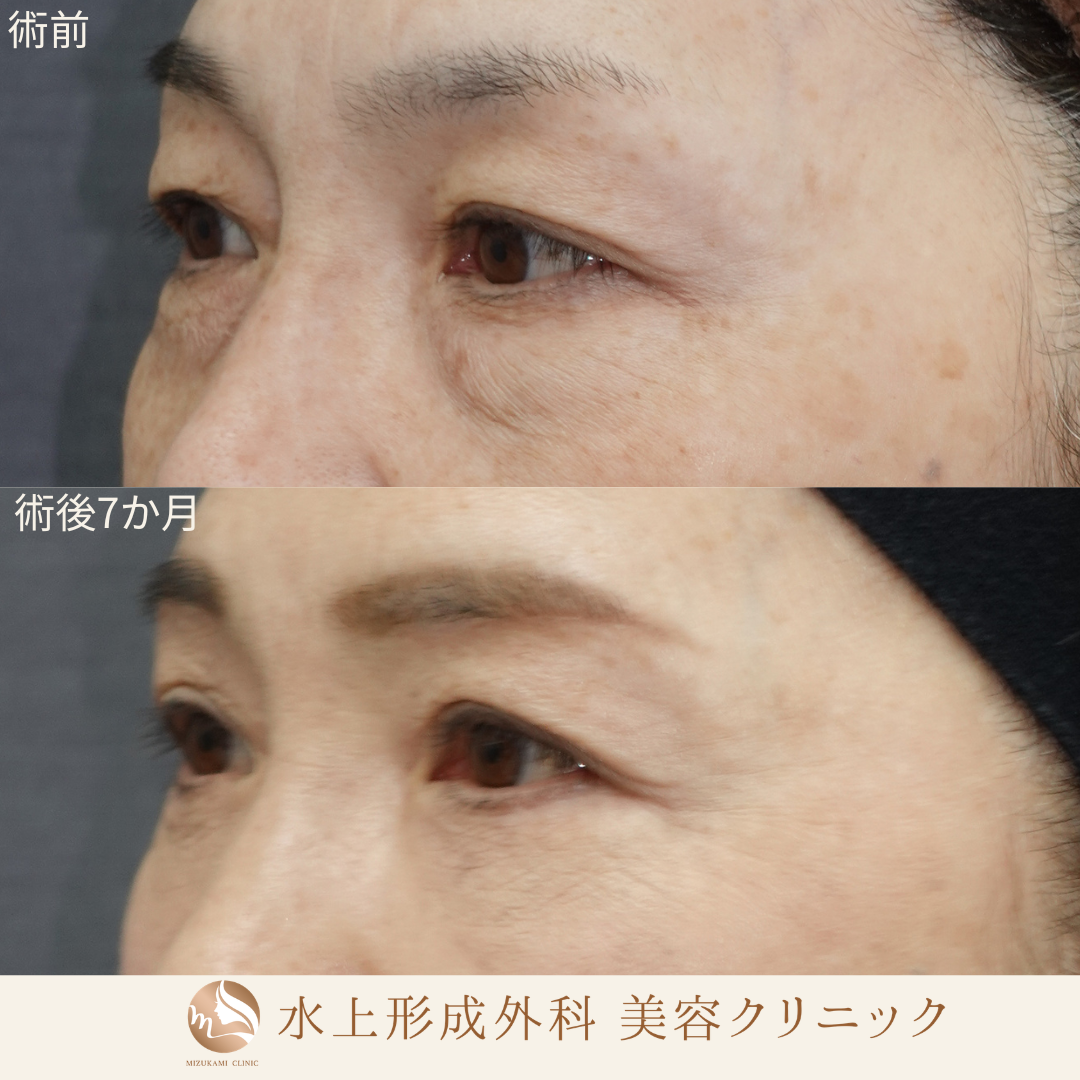 眉下切開、クマ取り（表ハムラ法）の症例写真3