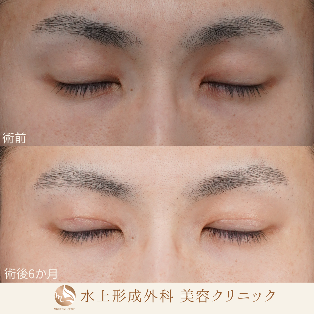 眼瞼下垂症手術・上眼瞼逆さまつ毛の症例写真3