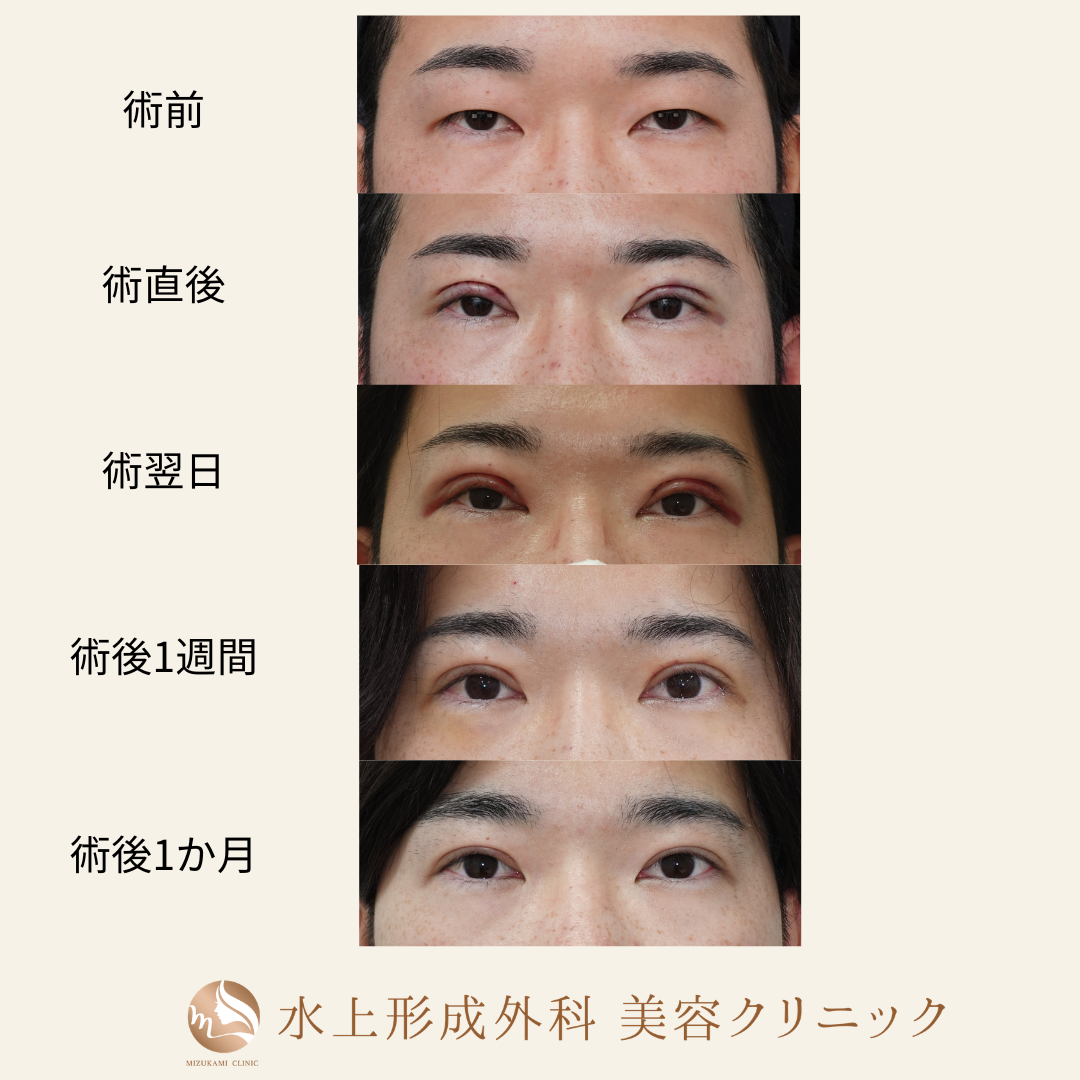 眼瞼下垂症手術の症例写真4