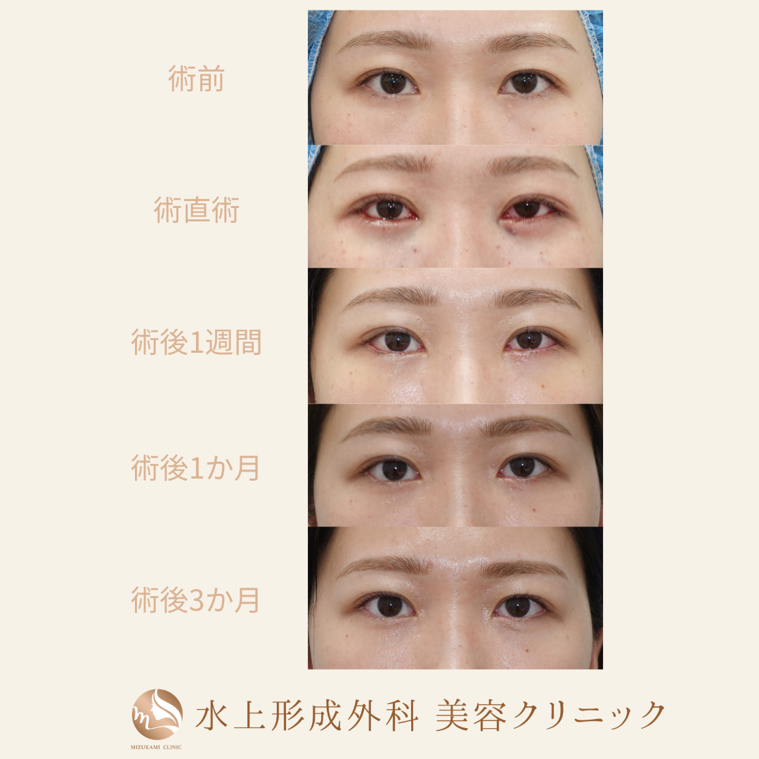 クマ取り（裏ハムラ法）の症例写真4