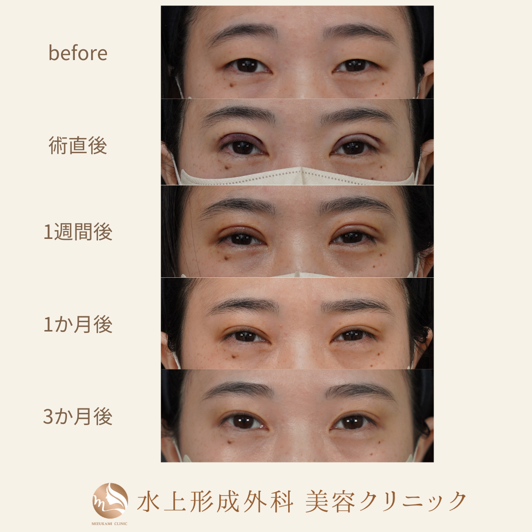 二重全切開法の症例写真4