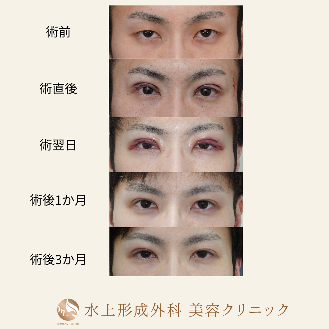 眼瞼下垂症手術・上眼瞼逆さまつ毛の症例写真4