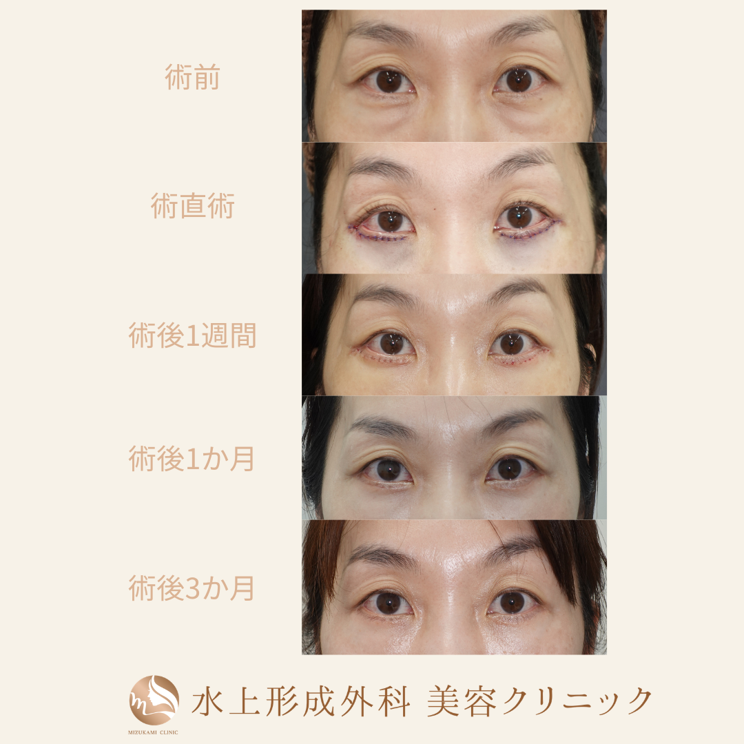 クマ取り（表ハムラ法)の症例写真5