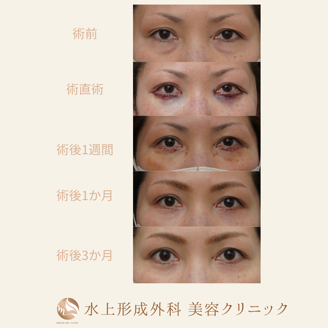 クマ取り（表ハムラ法)の症例写真5
