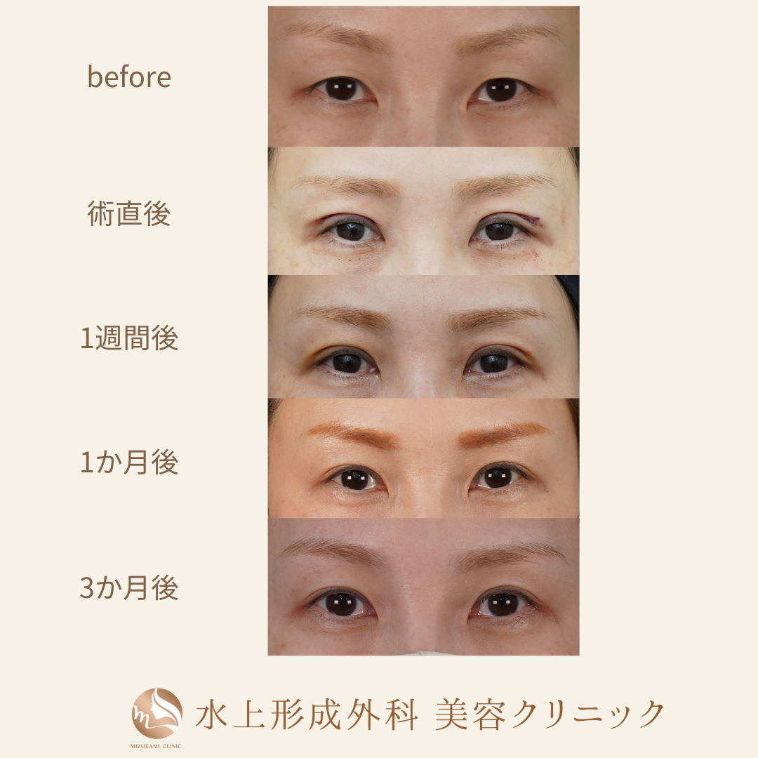 二重全切開法の症例写真3