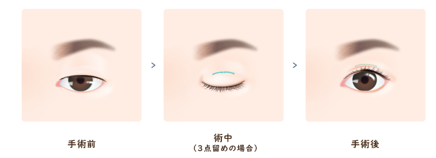 二重埋没法