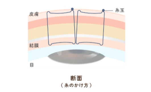 線留め（3点留め）