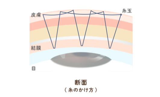自然癒着法